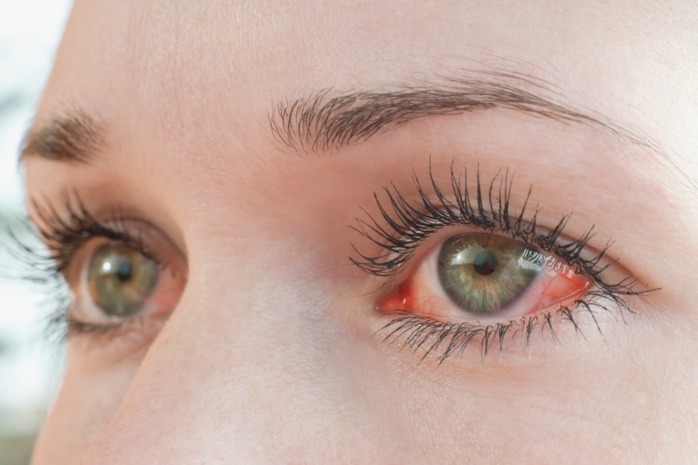Η ευλογιά των πιθήκων μπορεί να επηρεάσει τα μάτια μας